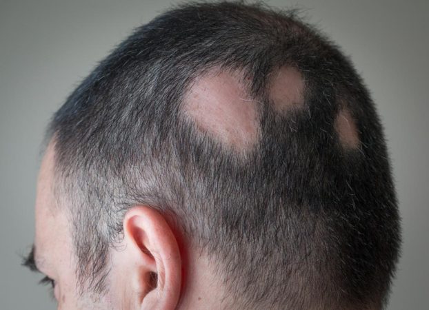 partial alopecia e1765446328926